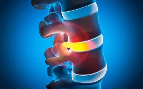 Degenerative Disc Disease