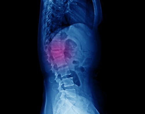Vertebral Compression Fractures